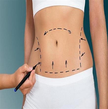 Abdominoplasty