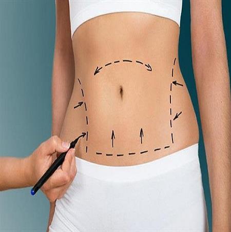 Abdominoplasty